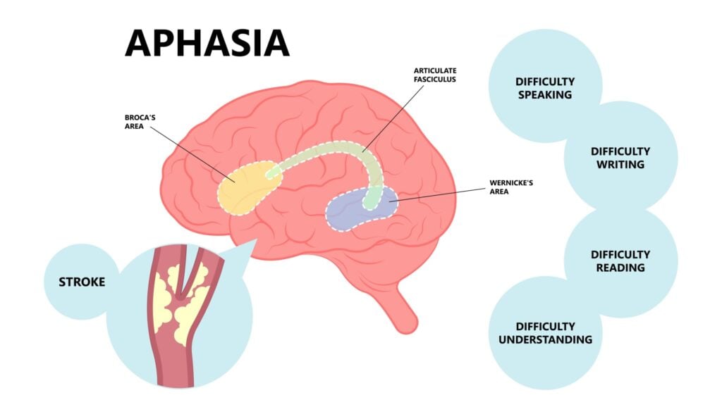 A diagram illustrating where in the brain aphasia can occur, labelled areas of broca's area, wernickes area, and articulate fasciculus