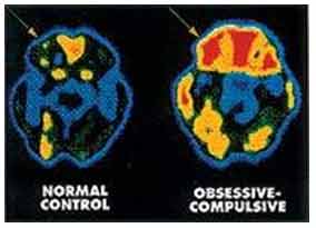 ocd brain image