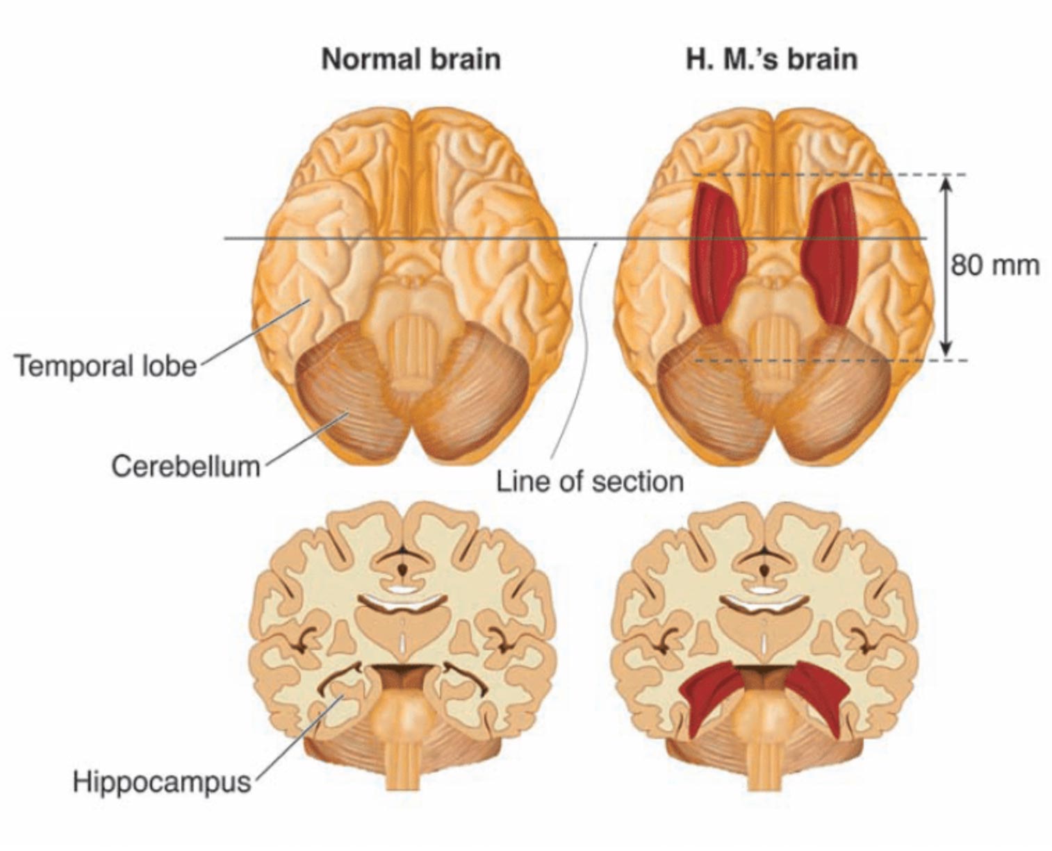 Bilateral resection of the anterior temporal lobe in patient HM. 